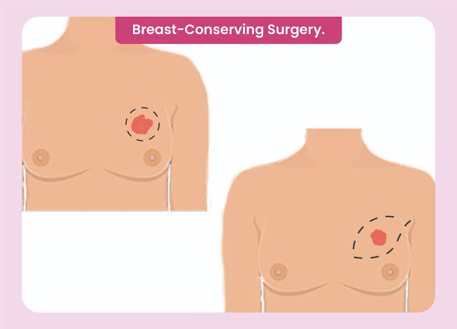 breast cn